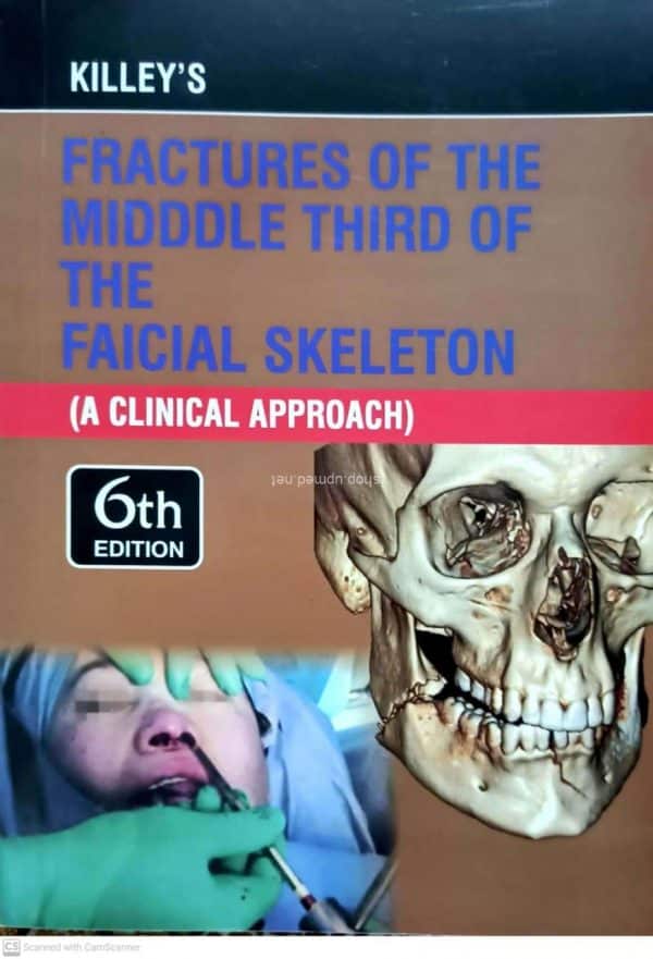 Killeys Fracture of the Middle Third of the Facial Skeleton 6th Edition