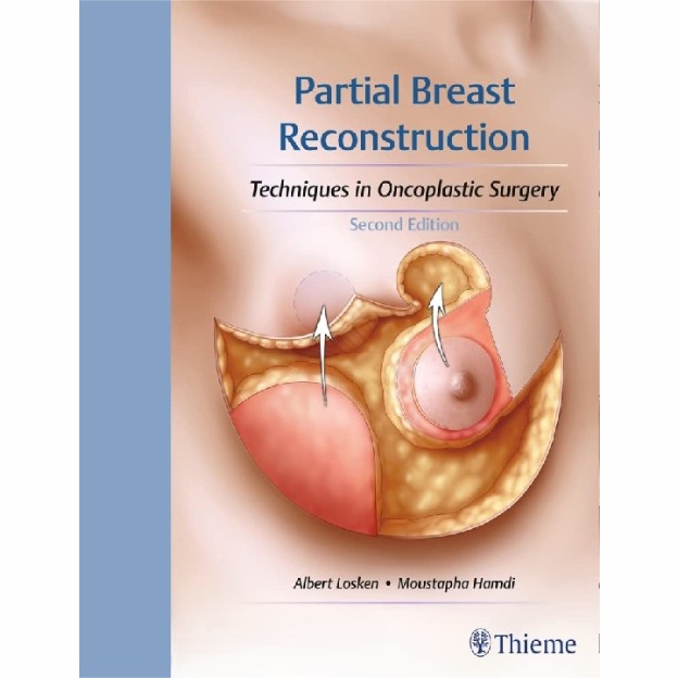 Partial Breast Reconstruction: Techniques in Oncoplastic Surgery 1 Partial Breast Reconstruction: Techniques in Oncoplastic Surgery